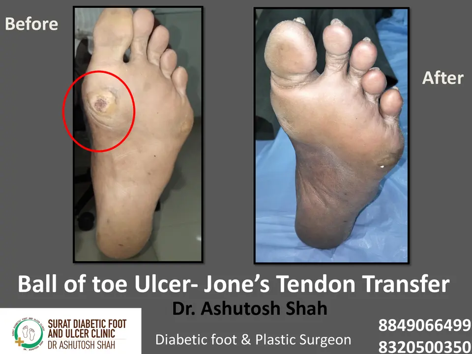 Diabetic Foot  PPT 3 checked by sir.pptx-26.webp